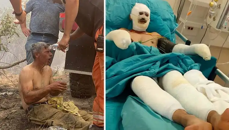 Yanıyorum Diye Feryat Eden Orman İşçisinin Durumu Üzerine Son Gelişmeler