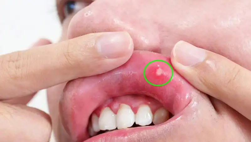 Kanserin Sessiz Uyarısı: Dil Kanseri Belirtilerini Göz Ardı Eden Bir Hayat Hikayesi